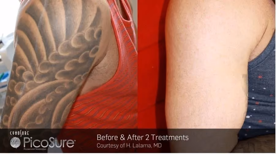 Before and after PicoSure laser tattoo removal treatment on a shoulder tattoo