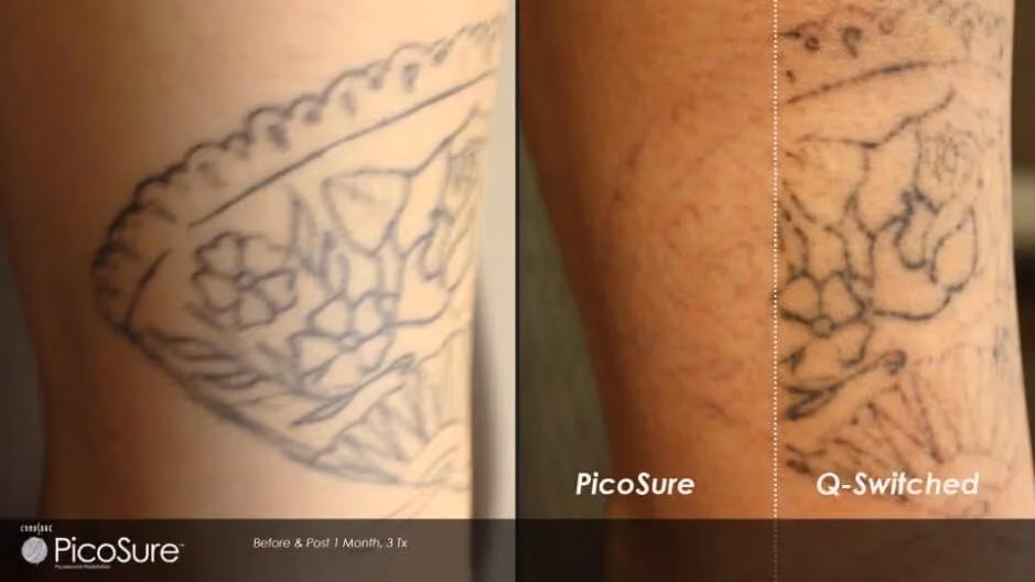 Comparison of PicoSure and Q-Switched laser tattoo removal results