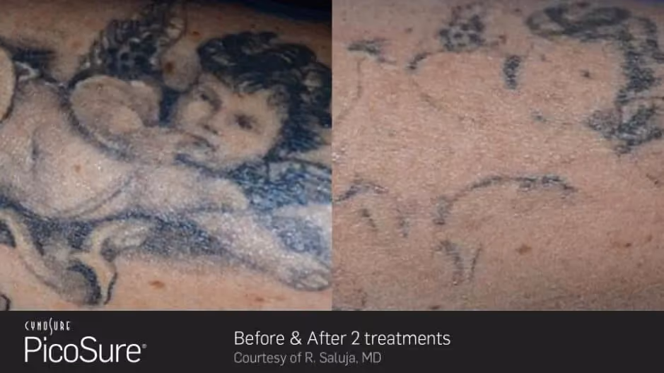 Before and after PicoSure laser tattoo removal treatment on a portrait tattoo