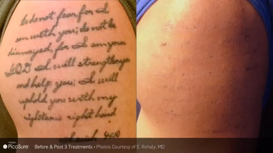 Before and after PicoSure laser tattoo removal treatment on a script tattoo