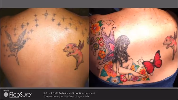 Before and after PicoSure laser treatment preparing a tattoo for a cover-up