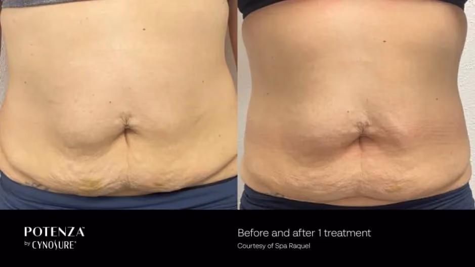 Potenza before and after abdominal skin tightening treatment results