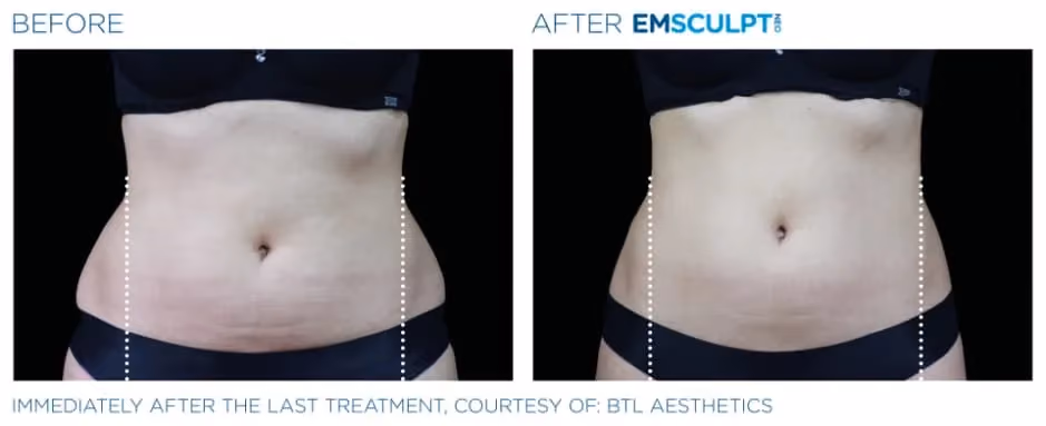 Emsculpt Neo before and after abdominal body contouring results