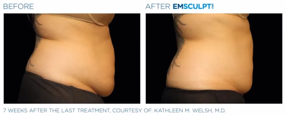 Emsculpt Neo before and after flank body contouring results