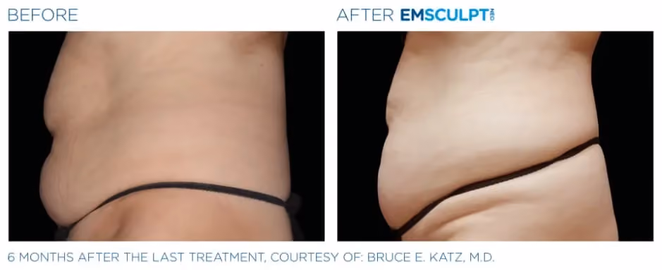Emsculpt Neo before and after lower abdomen body contouring results