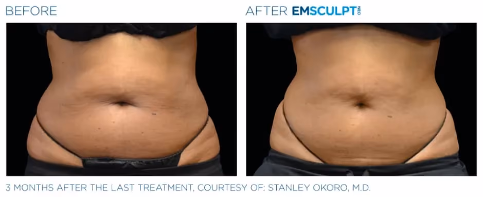 Emsculpt Neo before and after abdominal sculpting treatment results