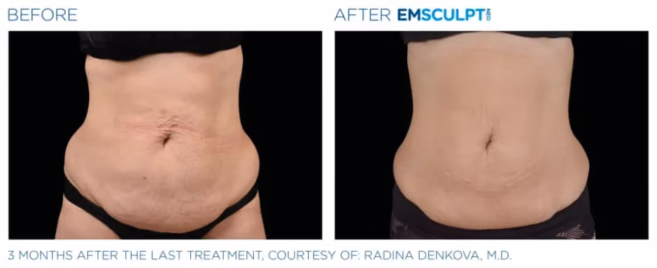 Emsculpt Neo before and after waistline contouring results