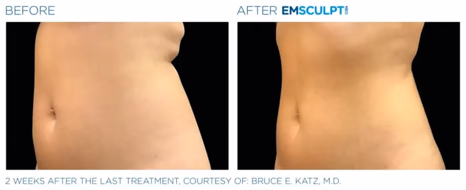 Emsculpt Neo before and after side profile body contouring results