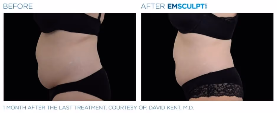 Emsculpt Neo before and after body sculpting treatment results