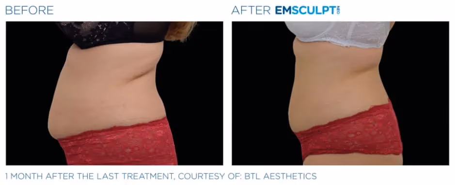 Emsculpt Neo before and after side waist body contouring results