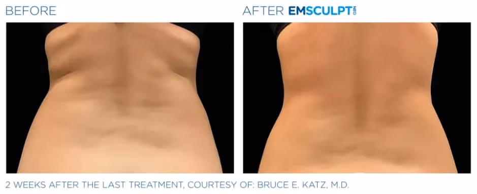 Emsculpt Neo before and after back and flank body contouring results  Or, if you want to be a bit more anatomical:
