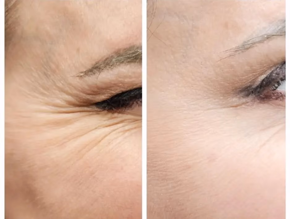 Before and after Botox treatment for forehead lines with eyes closed