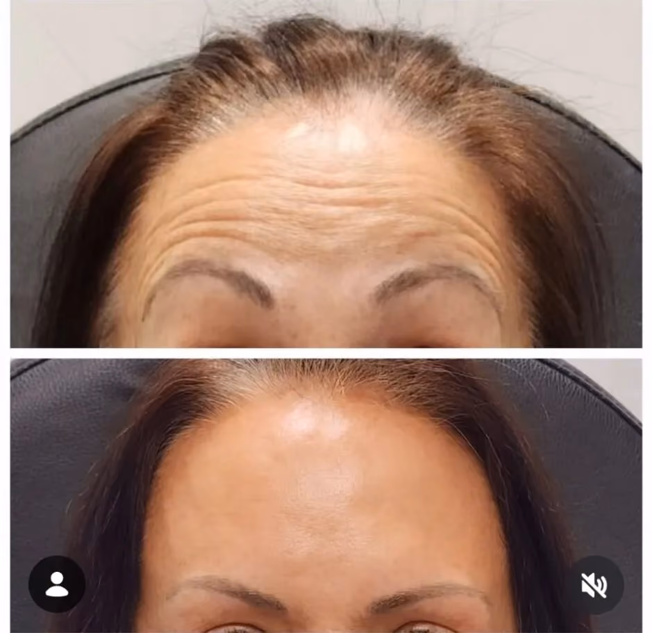 Before and after Botox treatment for glabellar lines