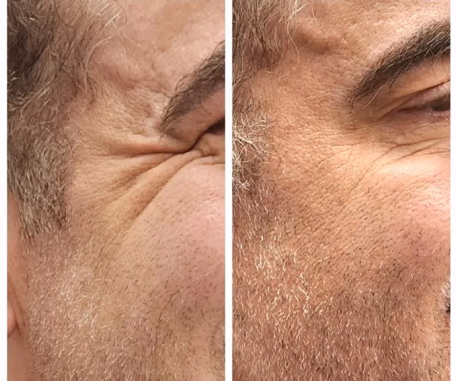 Before and after Botox treatment for forehead lines