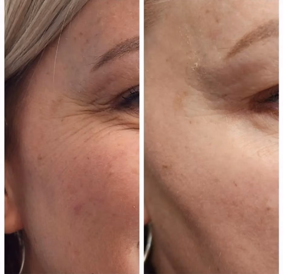 Before and after Botox treatment for crow's feet in a male patient