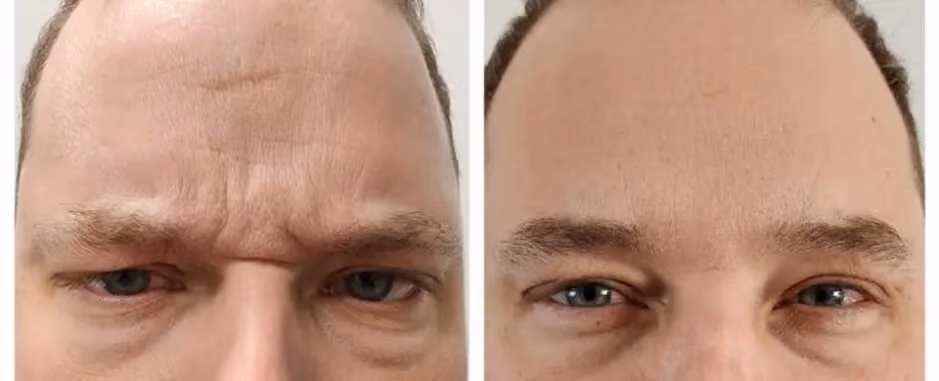 Before and after Botox treatment for glabellar frown lines