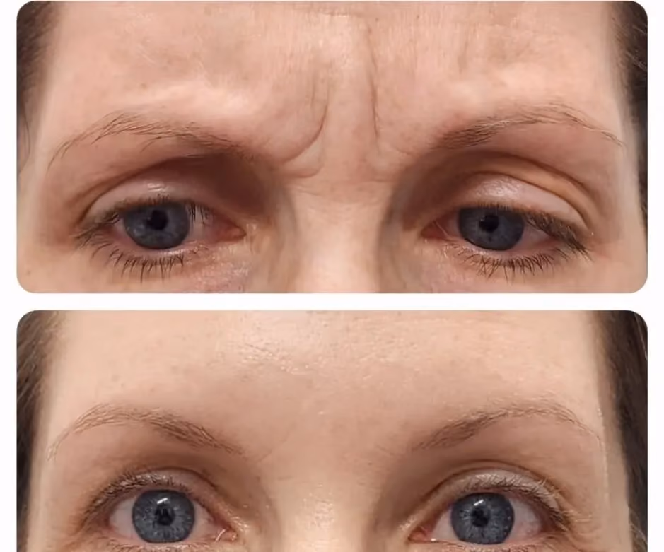 Before and after Botox treatment for forehead lines