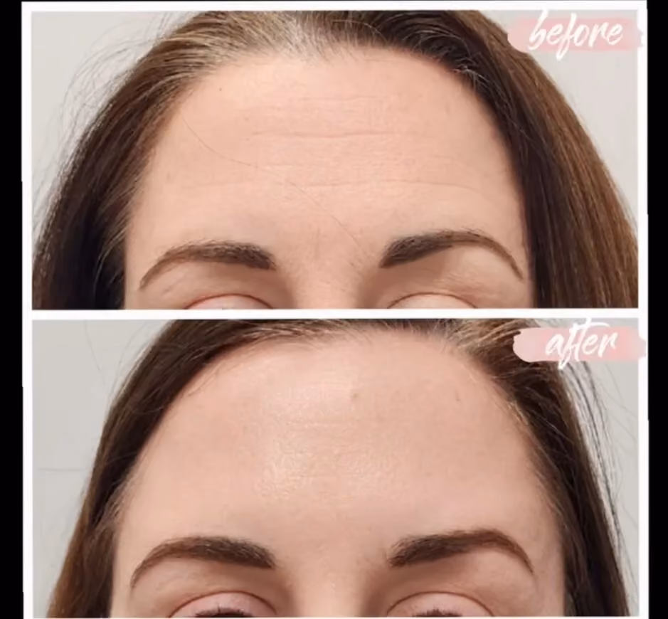 Before and after Botox treatment for forehead wrinkles