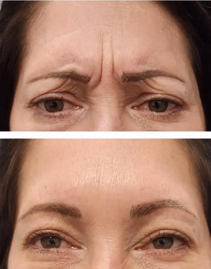 Before and after Botox treatment for crow's feet