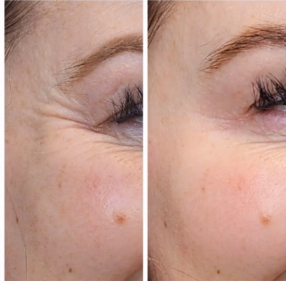 Before and after Botox treatment for under-eye wrinkles