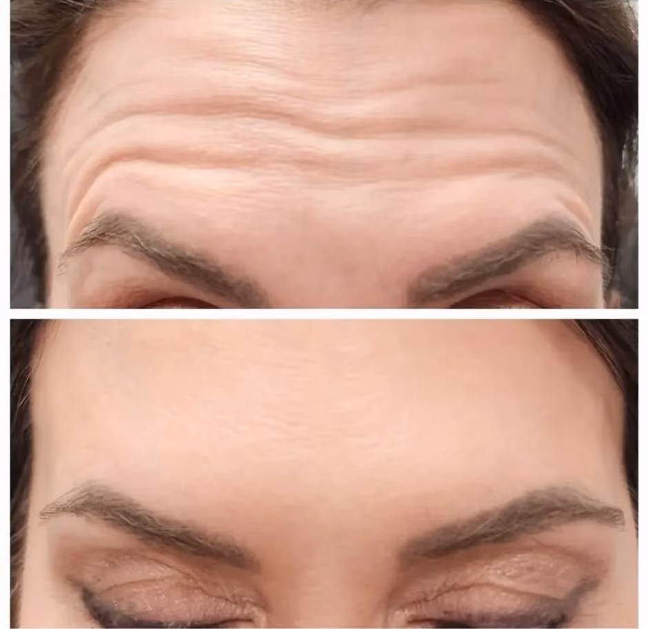 Before and after Botox treatment for forehead wrinkles