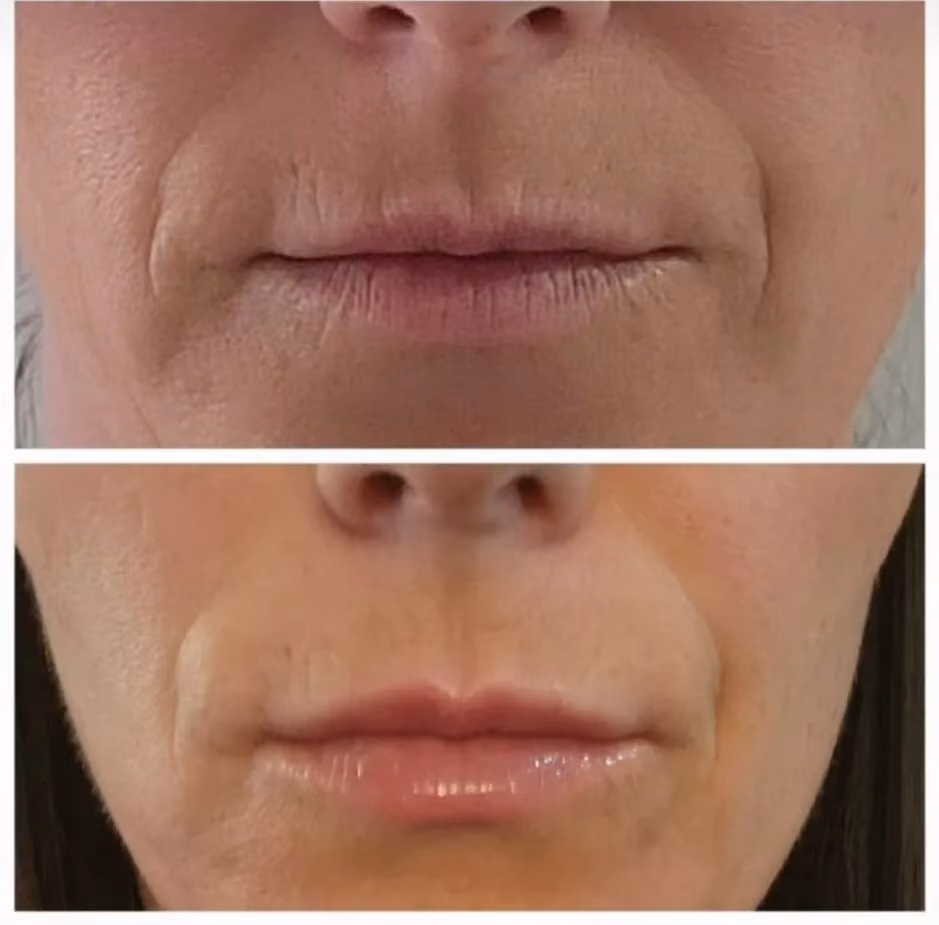 Before and after Botox treatment for upper lip lines
