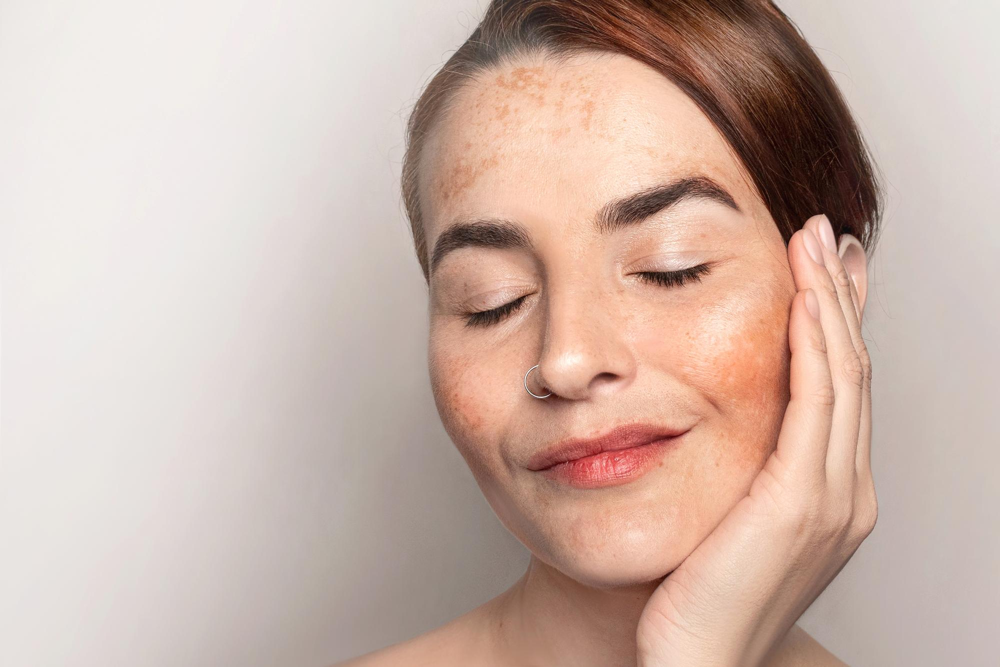 Woman shows face with pigmentation melasma freckles age spots