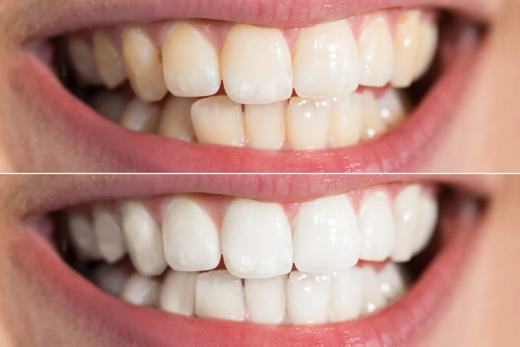In-Office vs. Take-Home Teeth Whitening: Which Option Is Right for You?