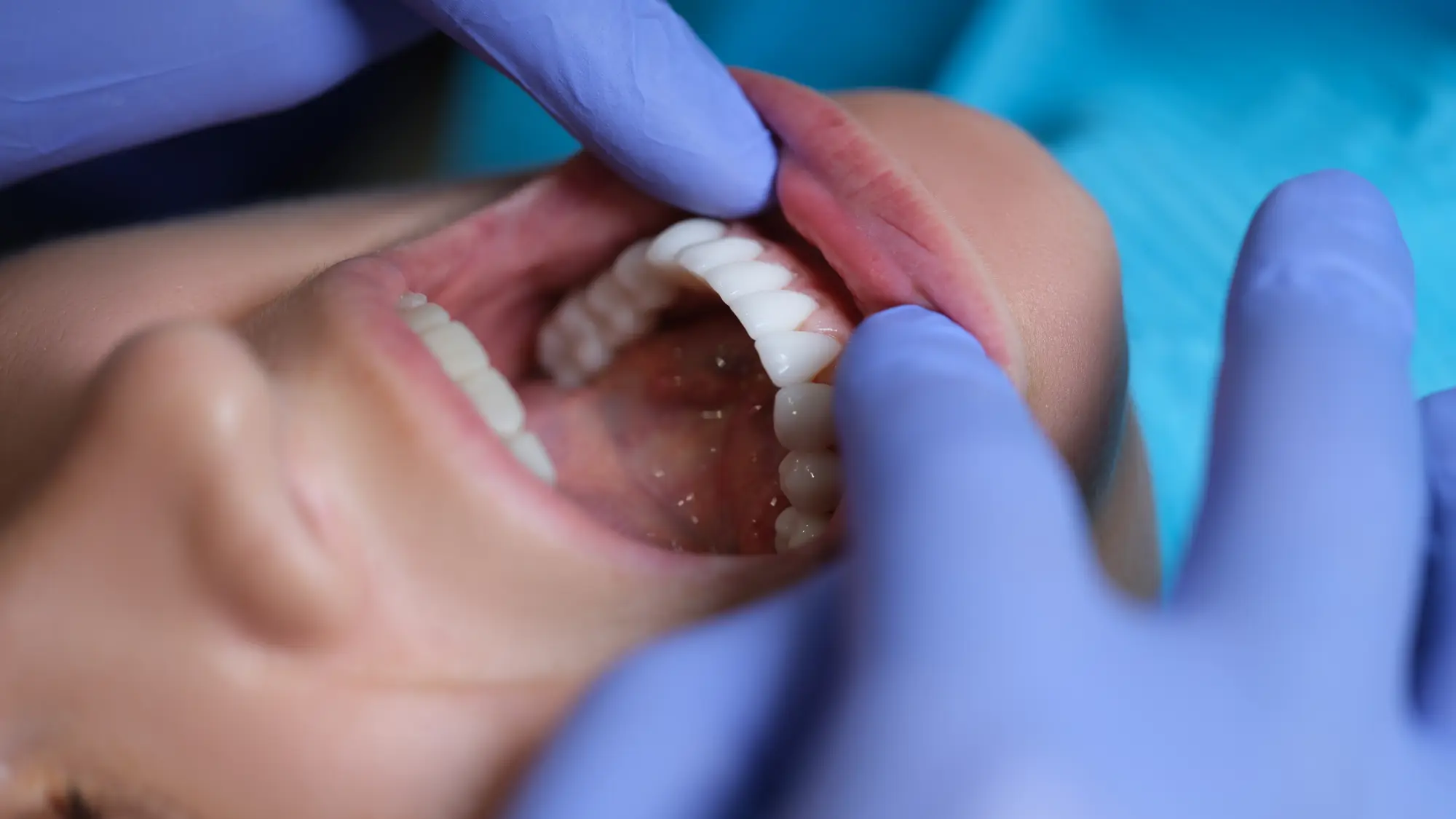 Veneers vs. Dental Implants: Which is Right for Your Overland Park Smile Makeover?