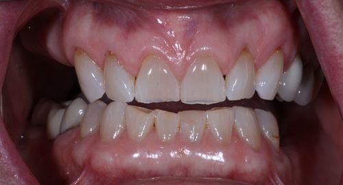 before and after treatment