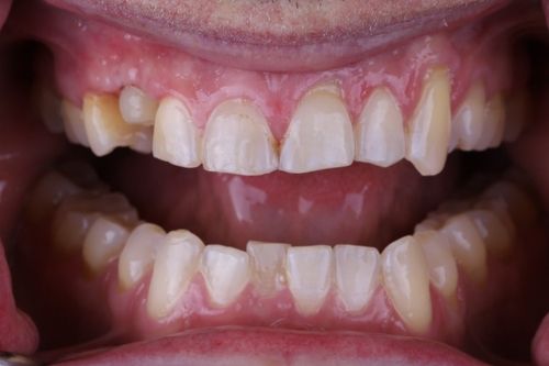 before and after treatment