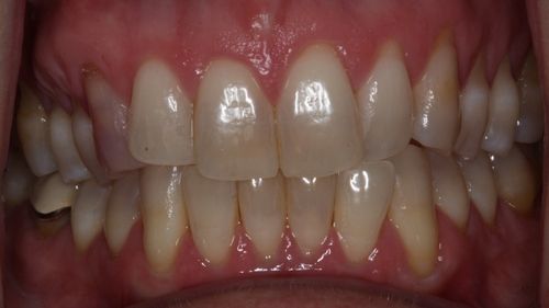 before and after treatment