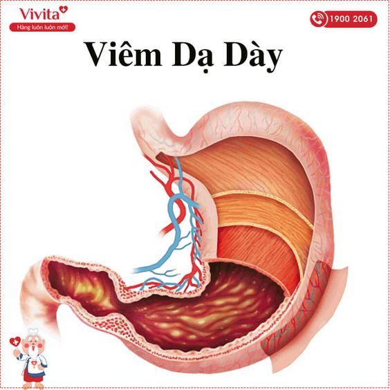 Triệu Chứng Viêm Dạ Dày - Cách Chữa Viêm Dạ Dày Đơn Giản Tại Nhà
