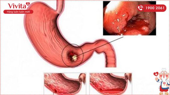 [HOT] Viêm Hạng Vị Dạ Dày Có Nguy Hiểm Không? Dấu Hiệu Và Cách Trị
