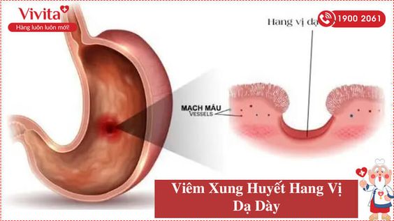 Viêm Xung Huyết Hang Vị Dạ Dày Là Bệnh Gì? Liệu Có Gây Nguy Hiểm?