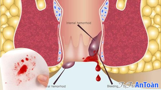 Bị Trĩ Ra Máu? TOP 4 Bài Thuốc Cầm Máu Bệnh Trĩ Tốt Nhất Từ Dân Gian