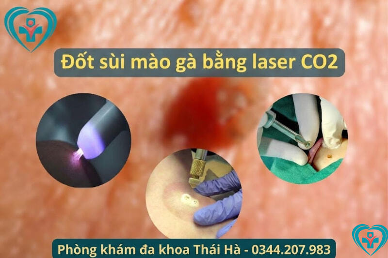 Đốt sùi mào gà là gì