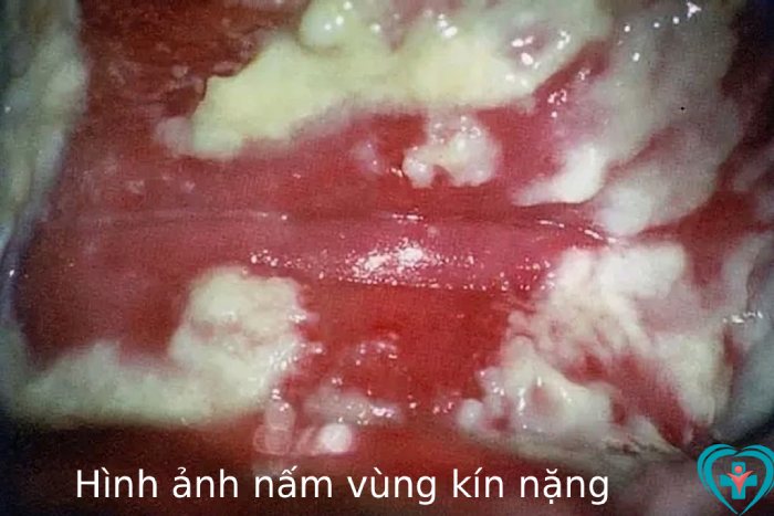 Hình ảnh bị nấm ở vùng kín giai đoạn nặng