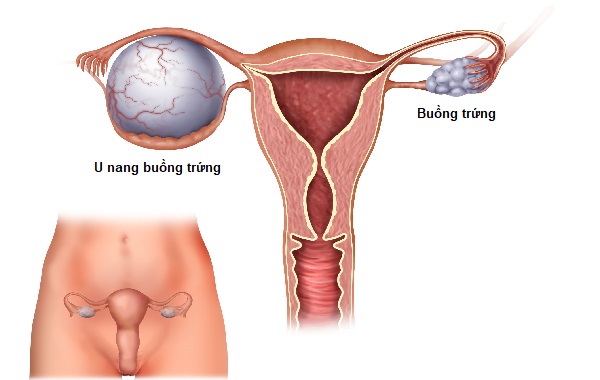 U nang buồng trứng là bệnh phụ khoa thường gặp