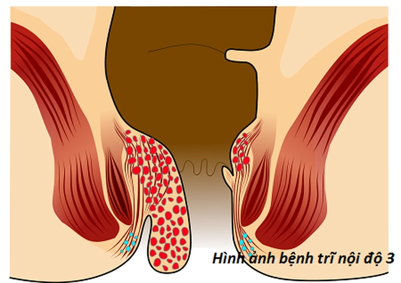 Hình ảnh bệnh trĩ nội và bệnh trĩ ngoại theo 4 cấp độ 3