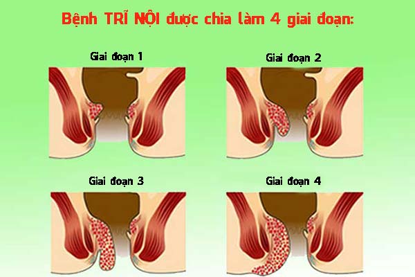 Bệnh trĩ nội