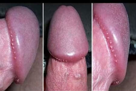 Hình ảnh sùi mào gà ở rãnh bao quy đầu