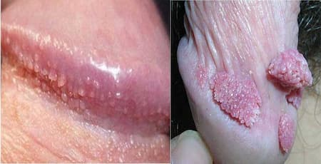 Hình ảnh sùi mào gà và chuỗi hạt ngọc dương vật
