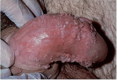 hình ảnh bộ phận sinh dục nữ bị sùi mào gà