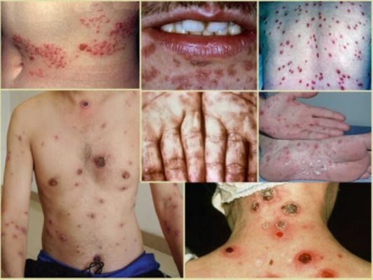 Triệu chứng bệnh giang mai khi xuất hiện