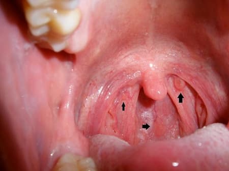 Hình ảnh sùi mào gà ở vòm họng