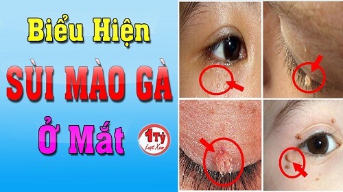 Hình ảnh bệnh sùi mào gà ở mắt