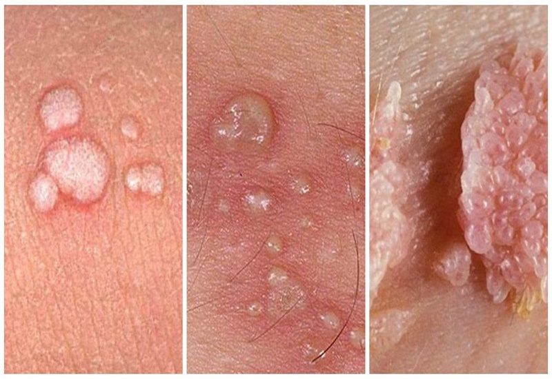 Sùi mào gà gây ra những mụn cóc, u nhú hình mào gà