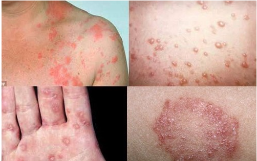 10 Hình ảnh bệnh lậu ở nam và nữ giới qua từng giai đoạn