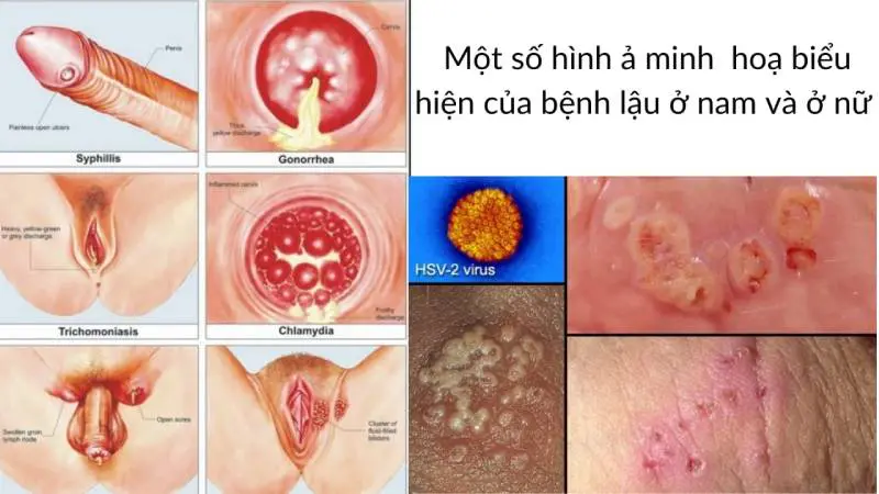 Hình ảnh minh họa bệnh lậu ở nam và nữ giới